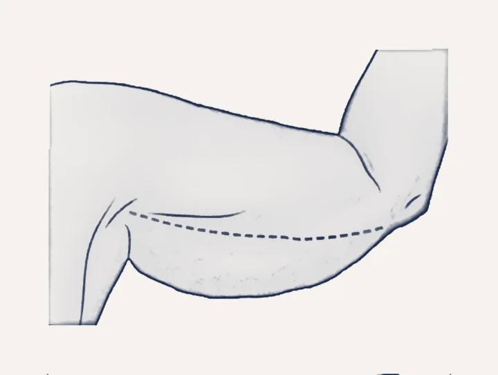 Sketch: the arm lift incision