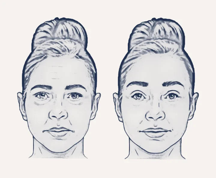 Sketch: forehead and brows before and after