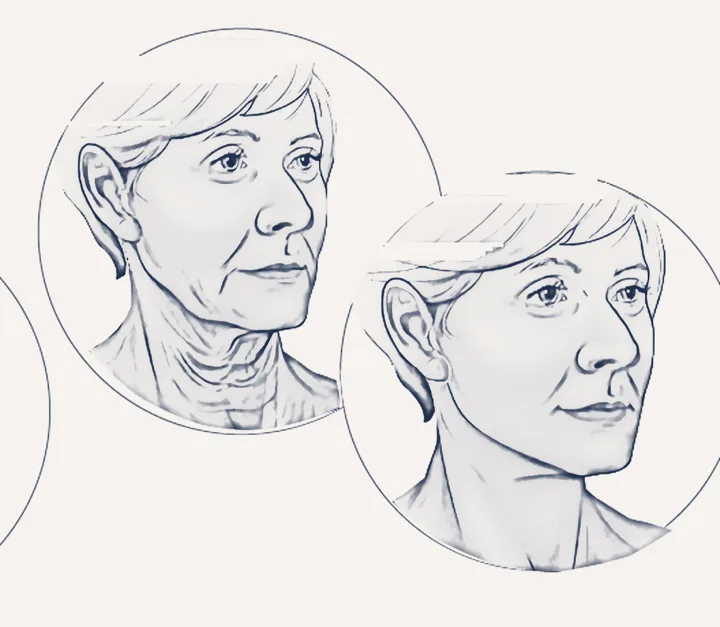 Sketch: neck before and after the facelift