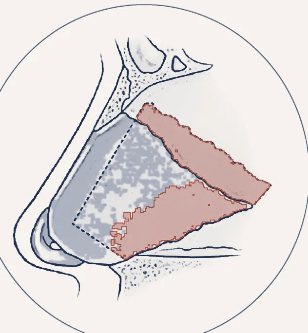 Sketch: the nasal hump removed
