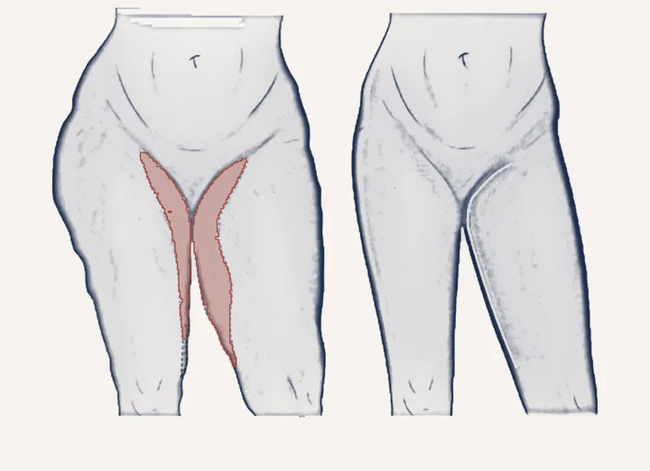 Sketch: thigh lift before and after