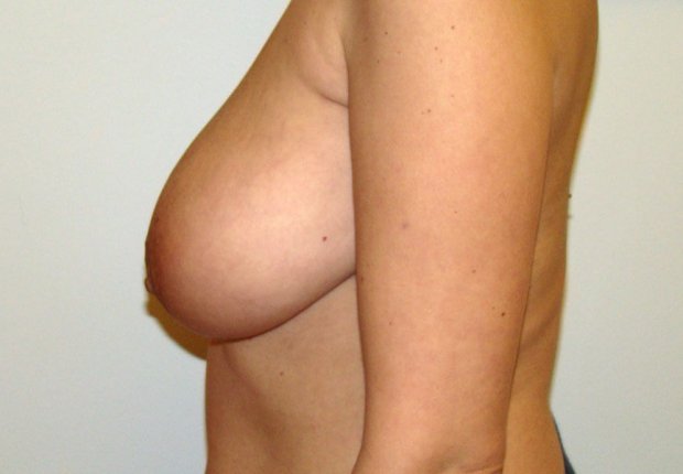 Ανάπλαση μαστών και θηλής μετά απο μαστεκτομή πλαϊνή φωτογραφία πριν το χειρουργείο εικόνα δεύτερη