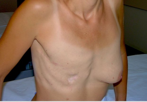 Αποκατάσταση μαστών μετά απο μαστεκτομή διαγώνια φωτογραφία πριν το χειρουργείο