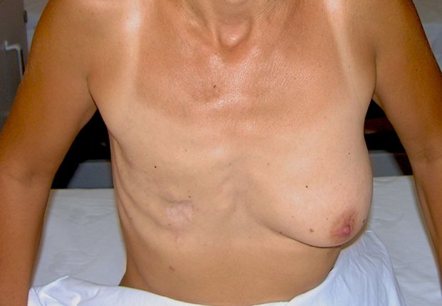 Αποκατάσταση μαστών μετά απο μαστεκτομή φωτογραφία πριν το χειρουργείο