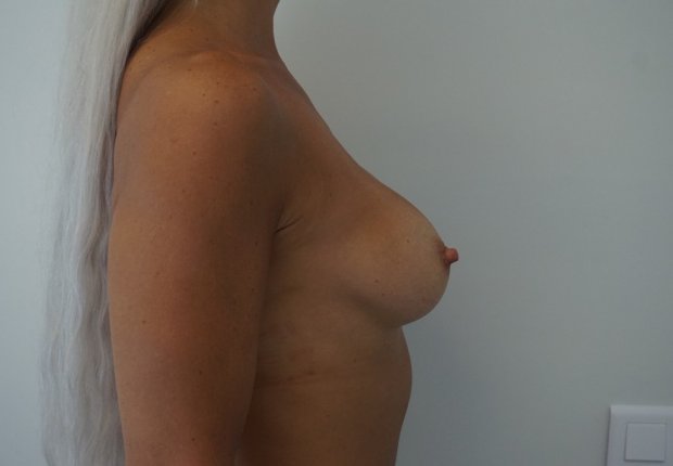 Αύξηση μαστών πλαϊνή φωτογραφία μετά το χειρουργείο