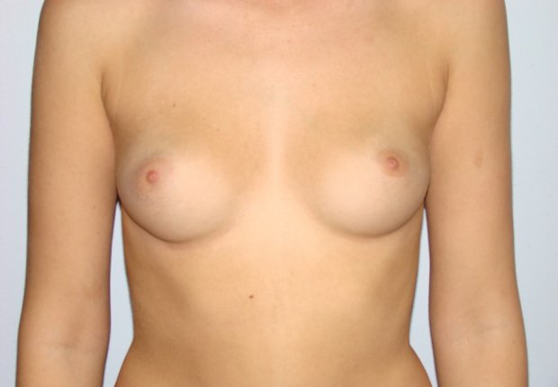 Αύξηση στήθους με λίπος μπροστινή φωτογραφία πριν το χειρουργείο