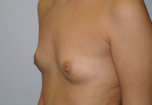 Αύξηση στήθους με ανατομικά ενθέματα διαγώνια φωτογραφία πριν το χειρουργείο εικόνα δεύτερη