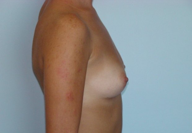 Αυξητική μαστών πλαϊνή φωτογραφία πριν το χειρουργείο