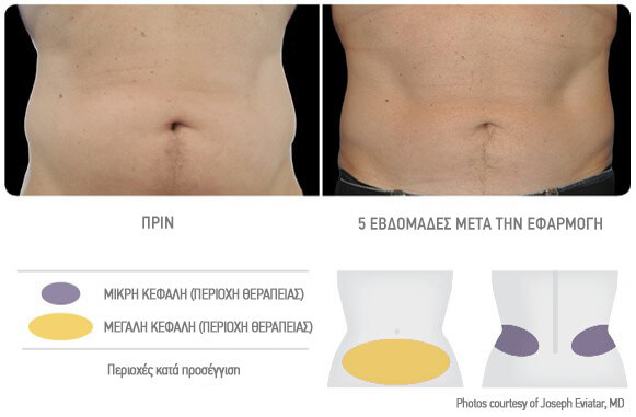coolsculpting-antras-therapeia