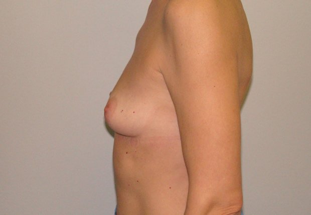 Φυσική αυξητική στήθους πλαϊνή φωτογραφία πριν το χειρουργείο 2