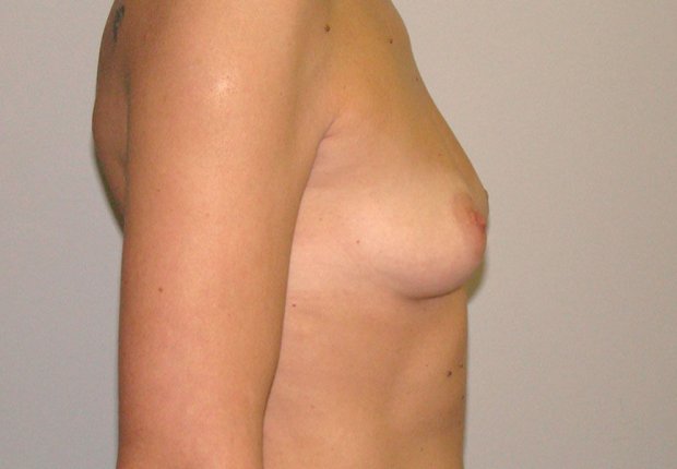 Φυσική αυξητική στήθους πλαϊνή φωτογραφία πριν το χειρουργείο