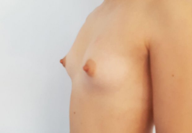 Λιπογλυπτική μαστών διαγώνια φωτογραφία πριν το χειρουργείο δεύτερη εικόνα