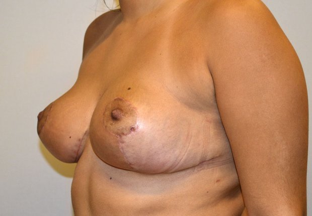 Μείωση μαστών διαγώνια φωτογραφία μετά το χειρουργείο Μείωση μαστών διαγώνια φωτογραφία πριν το χειρουργείο εικόνα δεύτερη
