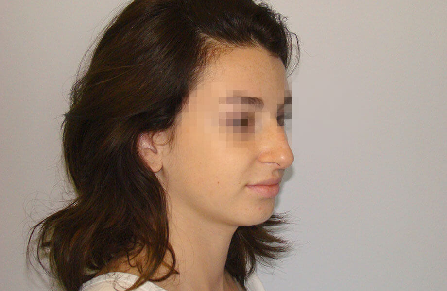 Ρινοπλαστική Γυναικείο Πρόσωπο Πριν την Επέμβαση Διαγώνια Λήψη