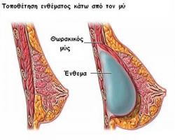 auksitiki stithous topothetisi enthematos katw apo ton mu 1