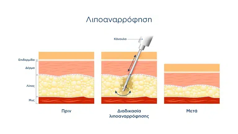 Lipoanarrofisi gia lipidima 768x432 1.png 1