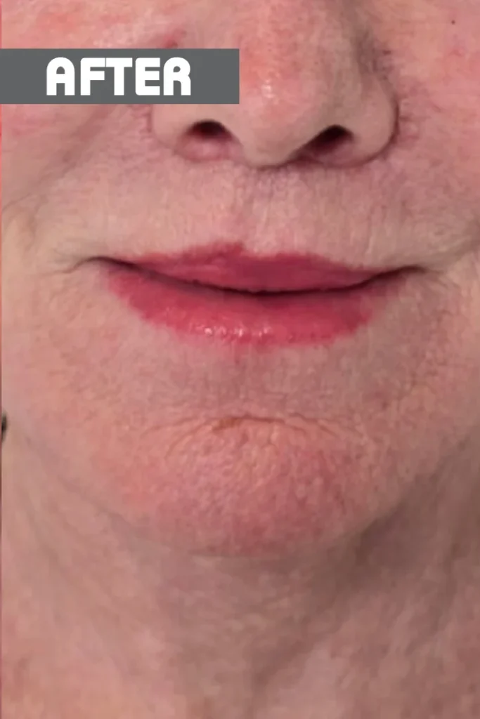 Lip lift: μετά την επέμβαση, μπροστά – γυναίκα 70+ ετών