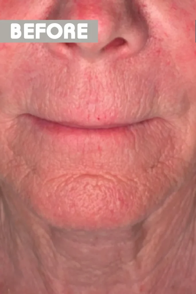 Lip lift: πριν την επέμβαση, μπροστά – γυναίκα 70+ ετών
