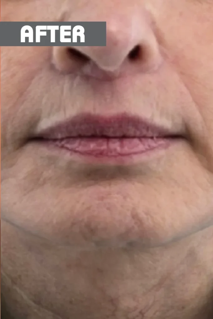 Lip lift: μετά την επέμβαση, μπροστά – γυναίκα 60–69 ετών