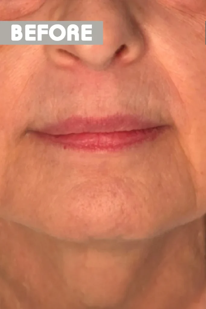 Lip lift: πριν την επέμβαση, μπροστά – γυναίκα 60–69 ετών