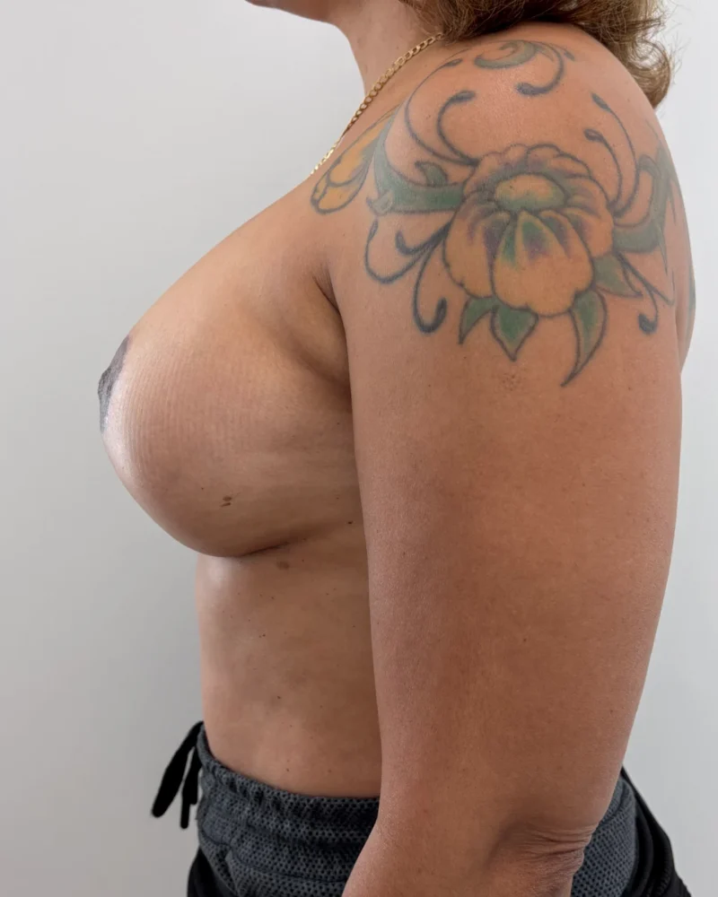 Breast augmentation and breast lift and breast revision: 6 months after surgery, profile left – woman, 50–60