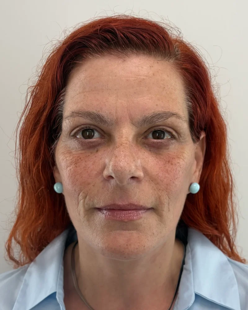 Deep plane facelift and upper blepharoplasty after: woman, 45–50, 7 months after surgery, front view