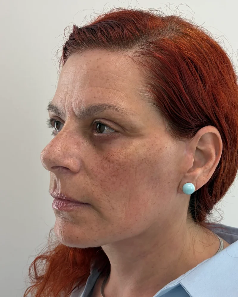 Deep plane facelift and upper blepharoplasty after: woman, 45–50, 7 months after surgery, oblique view, left