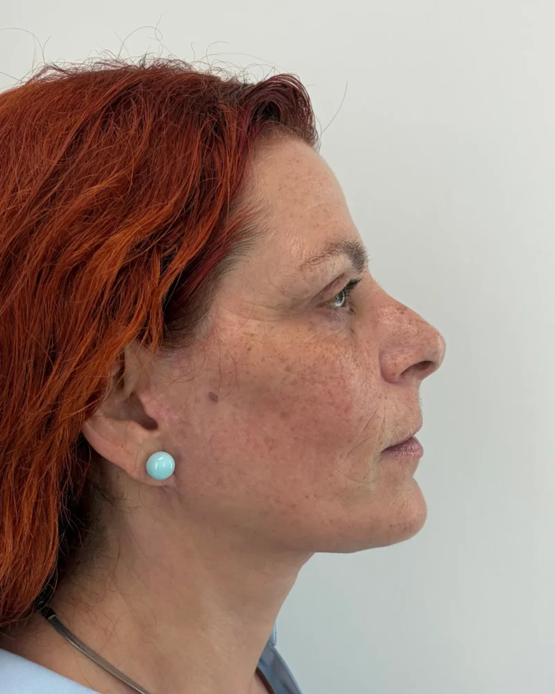 Deep plane facelift and upper blepharoplasty after: woman, 45–50, 7 months after surgery, oblique view, right