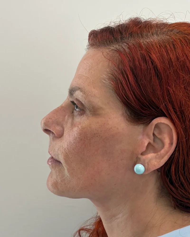 Deep plane facelift and upper blepharoplasty after: woman, 45–50, 7 months after surgery, side view, left