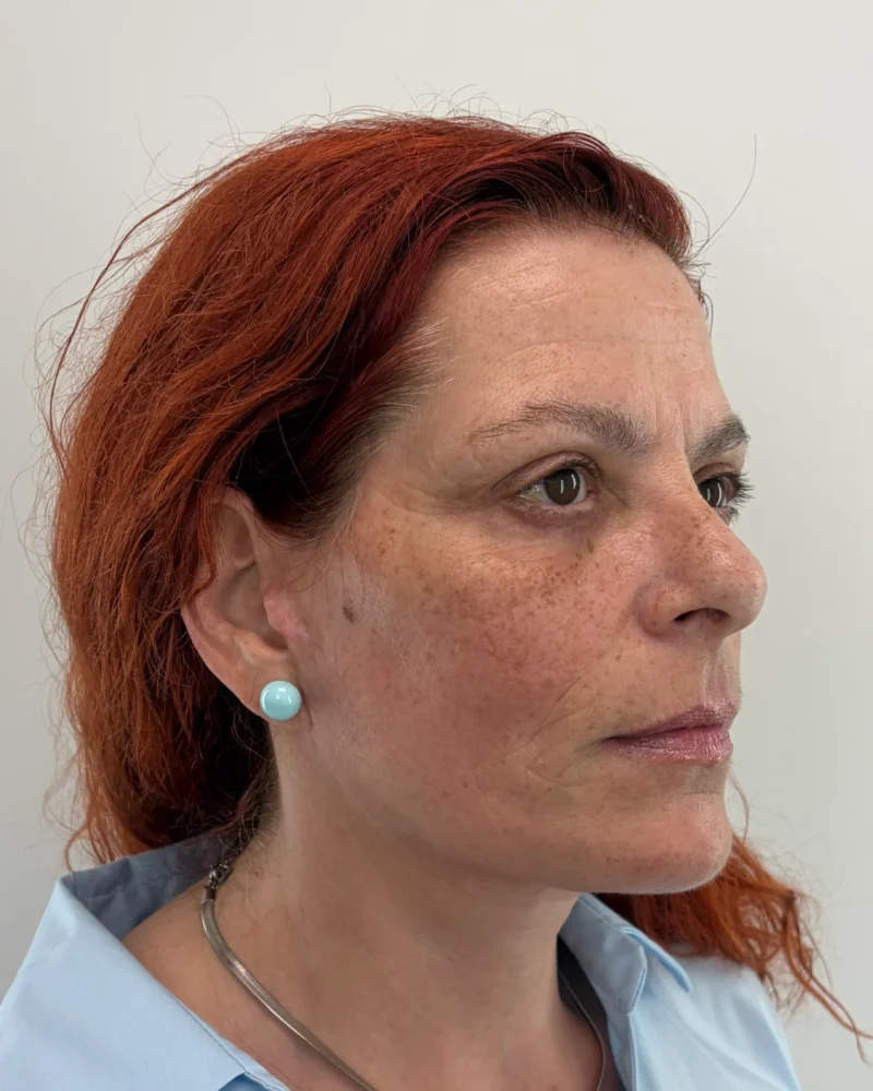 Deep plane facelift and upper blepharoplasty after: woman, 45–50, 7 months after surgery, side view, right