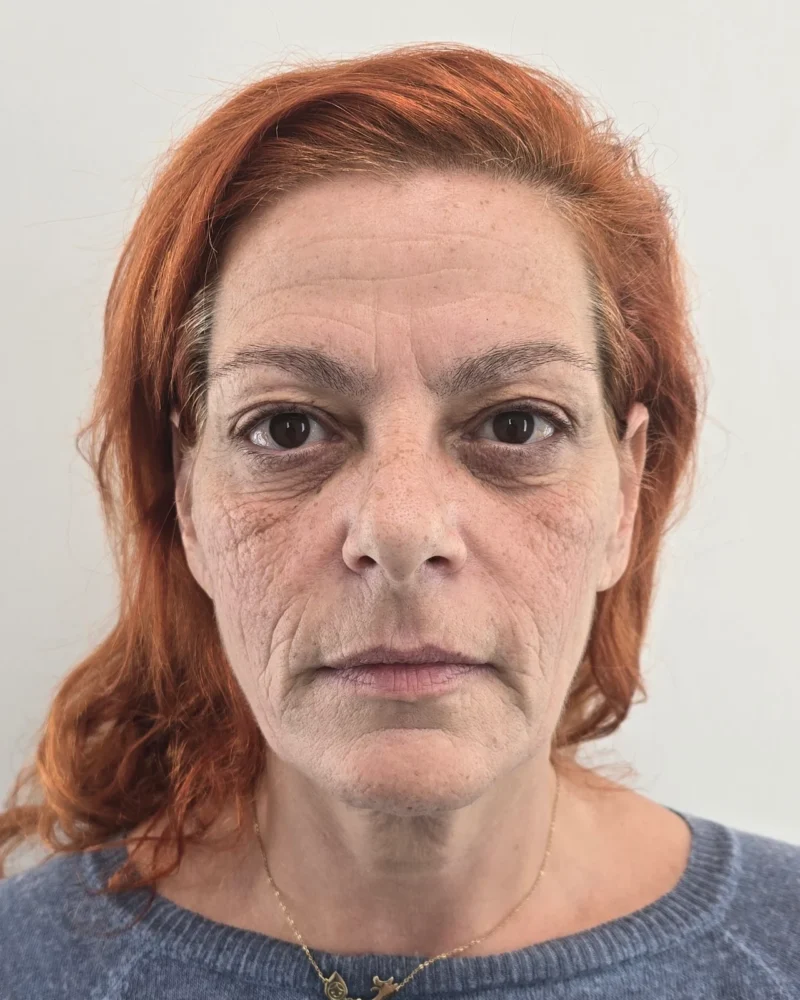 Deep plane facelift and upper blepharoplasty before: woman, 45–50, 7 months after surgery, front view