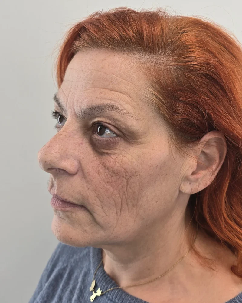Deep plane facelift and upper blepharoplasty before: woman, 45–50, 7 months after surgery, oblique view, left