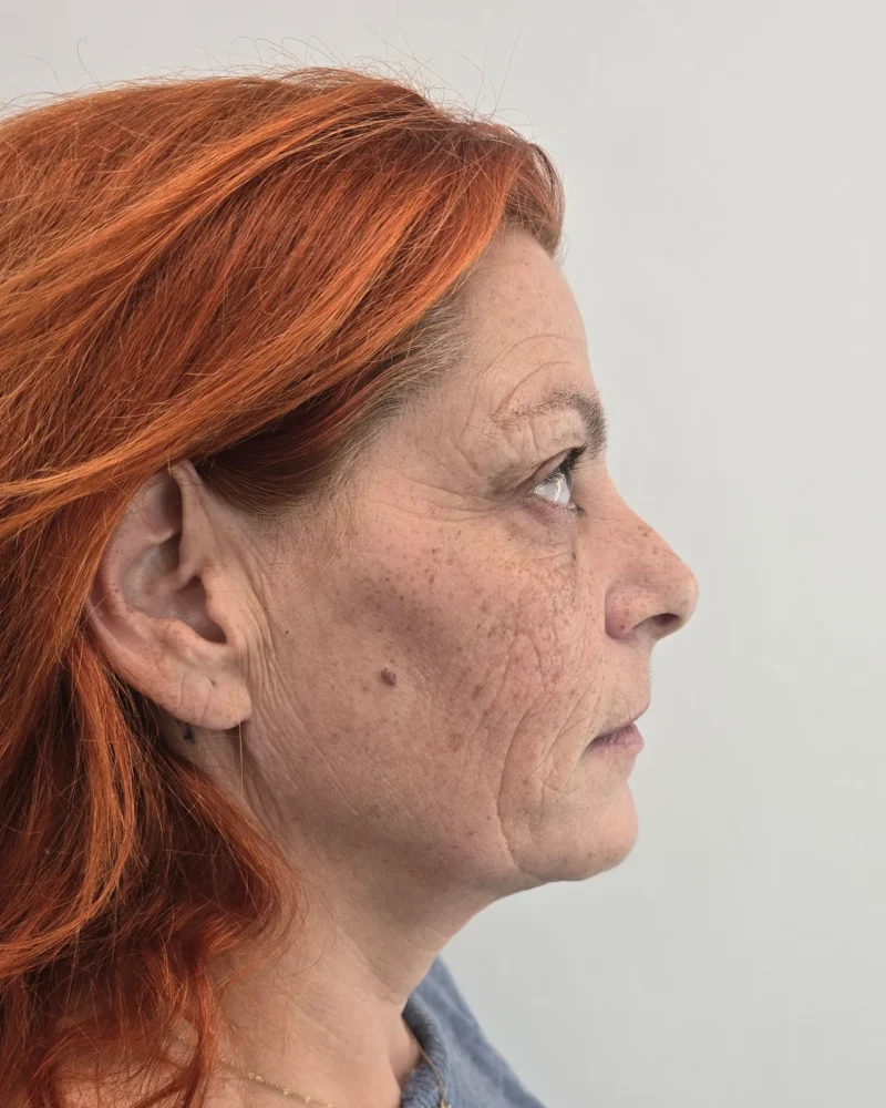 Deep plane facelift and upper blepharoplasty before: woman, 45–50, 7 months after surgery, oblique view, right