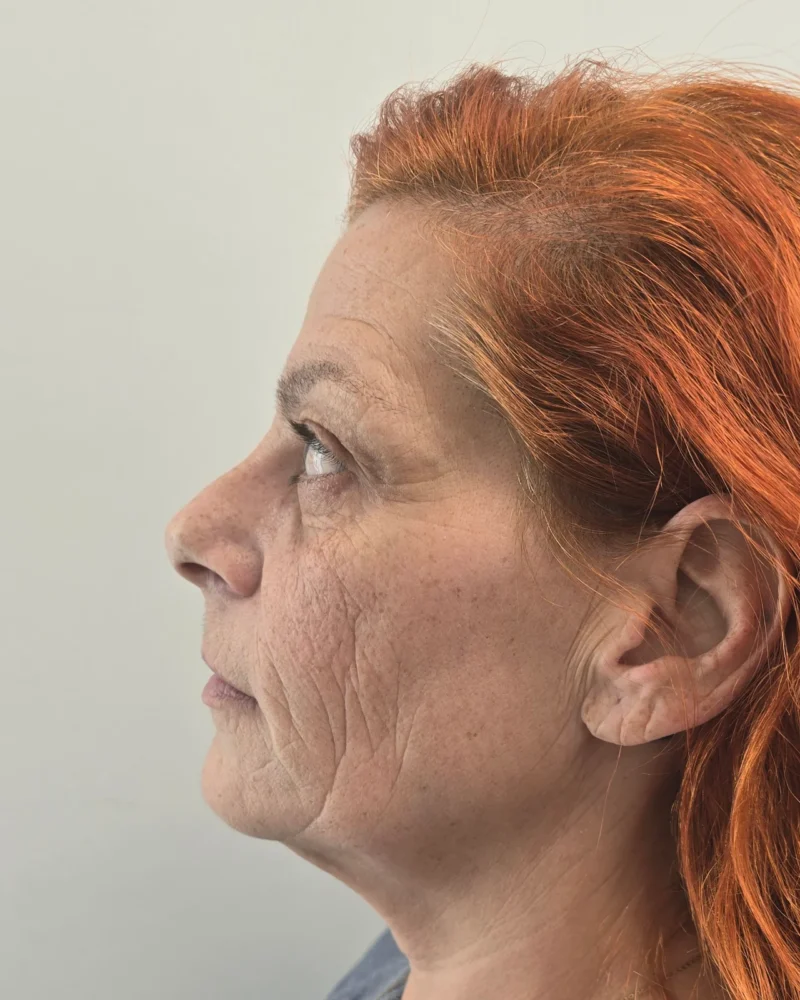 Deep plane facelift and upper blepharoplasty before: woman, 45–50, 7 months after surgery, side view, left