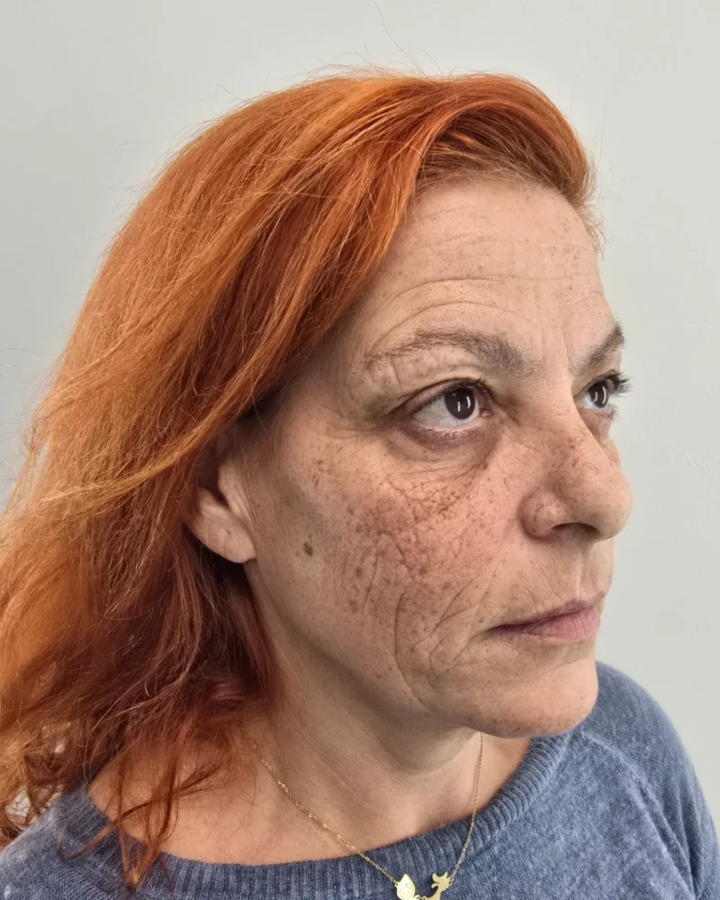 Deep plane facelift and upper blepharoplasty before: woman, 45–50, 7 months after surgery, side view, right