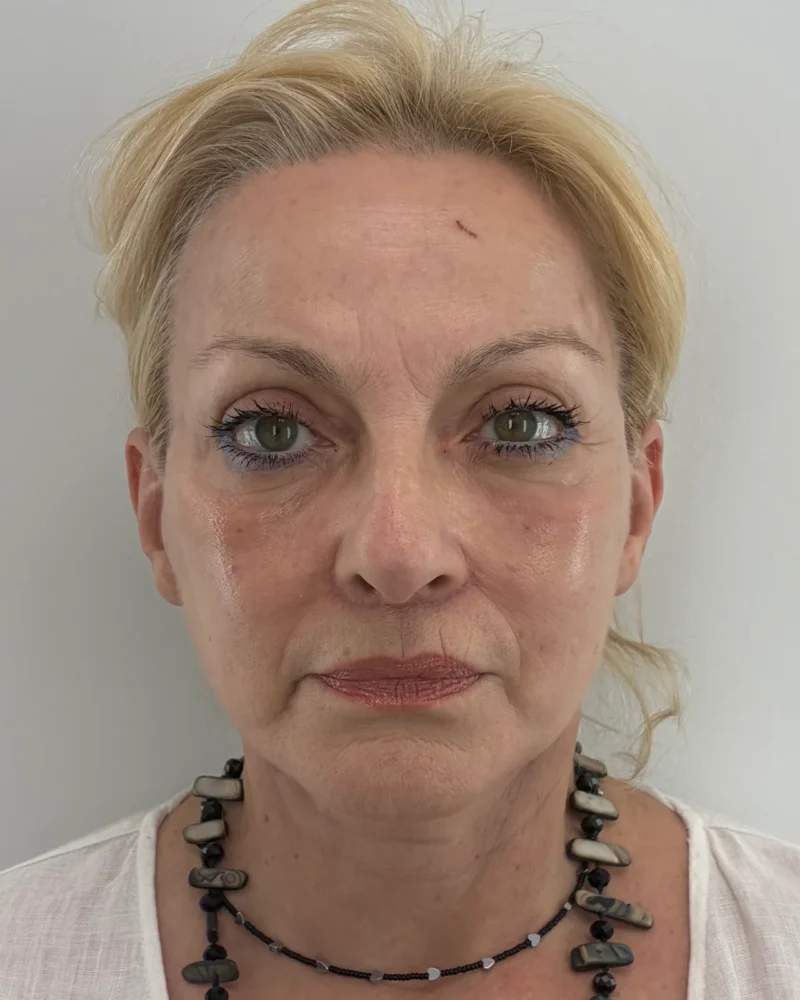 Deep plane facelift and lip lift after: woman, 60–70, 4 months after surgery, front view