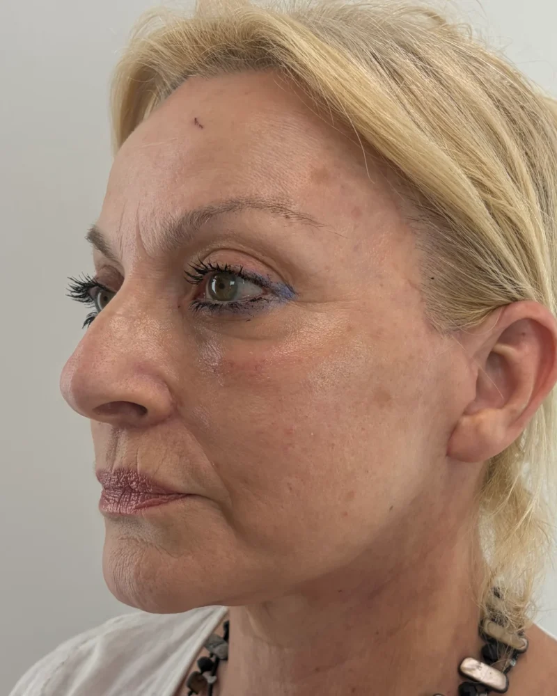 Deep plane facelift and lip lift after: woman, 60–70, 4 months after surgery, oblique view, left