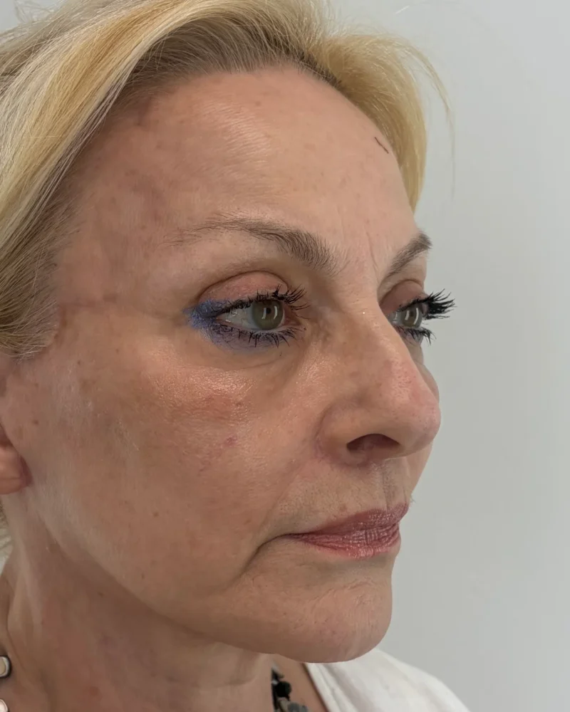 Deep plane facelift and lip lift after: woman, 60–70, 4 months after surgery, oblique view, right
