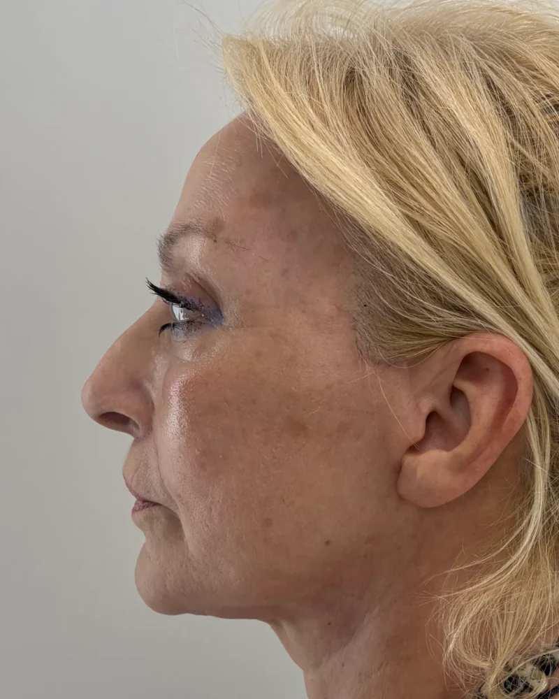 Deep plane facelift and lip lift after: woman, 60–70, 4 months after surgery, side view, left