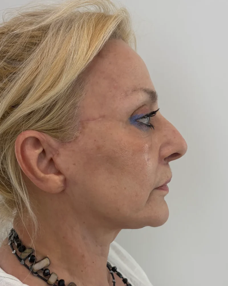 Deep plane facelift and lip lift after: woman, 60–70, 4 months after surgery, side view, right