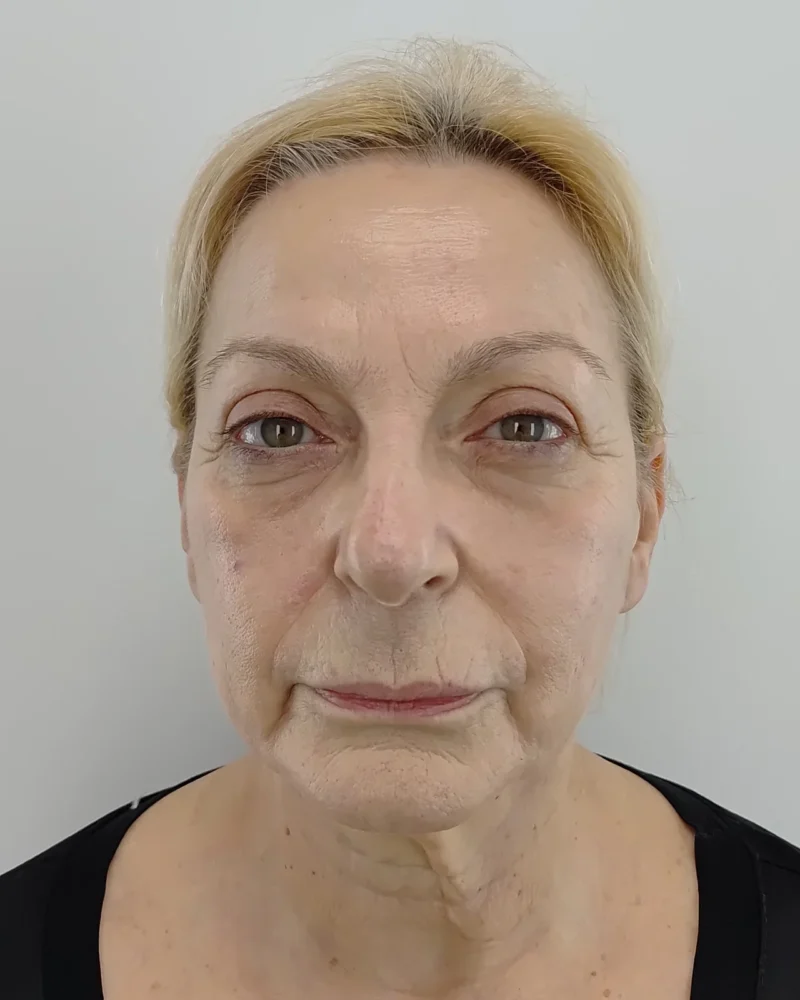Deep plane facelift and lip lift before: woman, 60–70, 4 months after surgery, front view