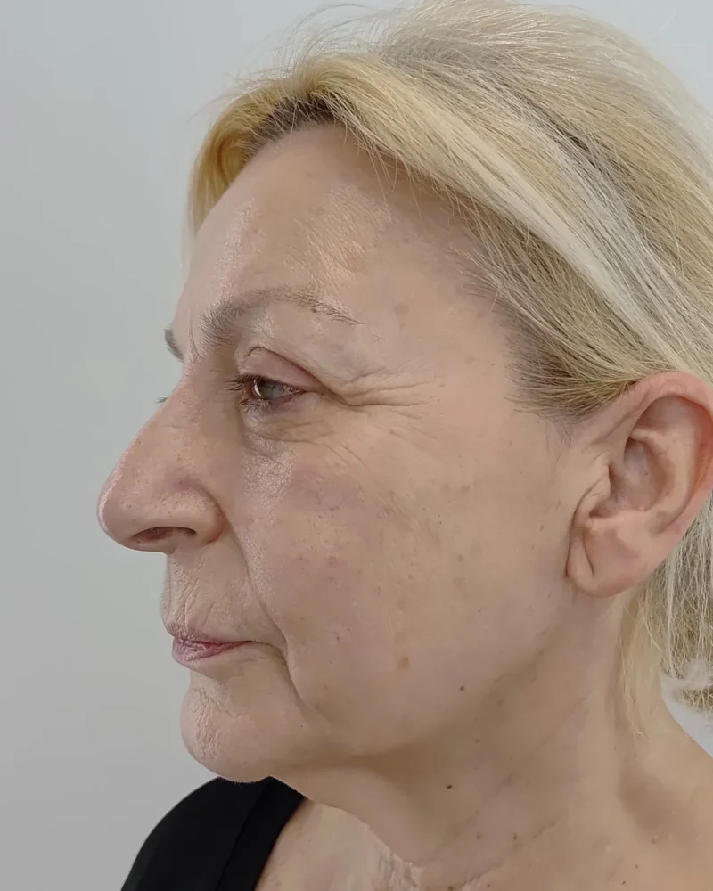 Deep plane facelift and lip lift before: woman, 60–70, 4 months after surgery, oblique view, left