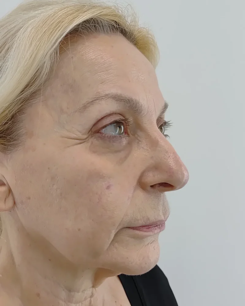 Deep plane facelift and lip lift before: woman, 60–70, 4 months after surgery, oblique view, right
