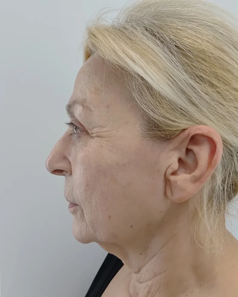 Deep plane facelift and lip lift before: woman, 60–70, 4 months after surgery, side view, left