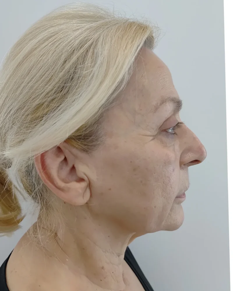 Deep plane facelift and lip lift before: woman, 60–70, 4 months after surgery, side view, right