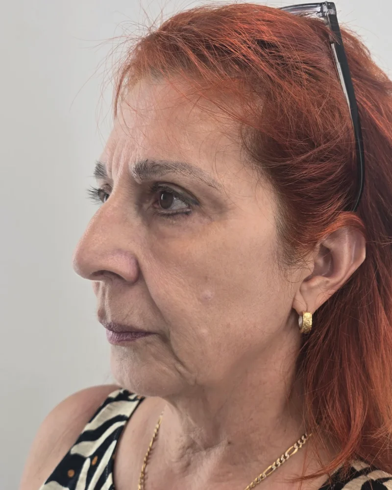 Deep plane λίφτινγκ προσώπου πριν: γυναίκα 50–60 ετών, 3 μήνες μετά την επέμβαση, λοξή λήψη αριστερή