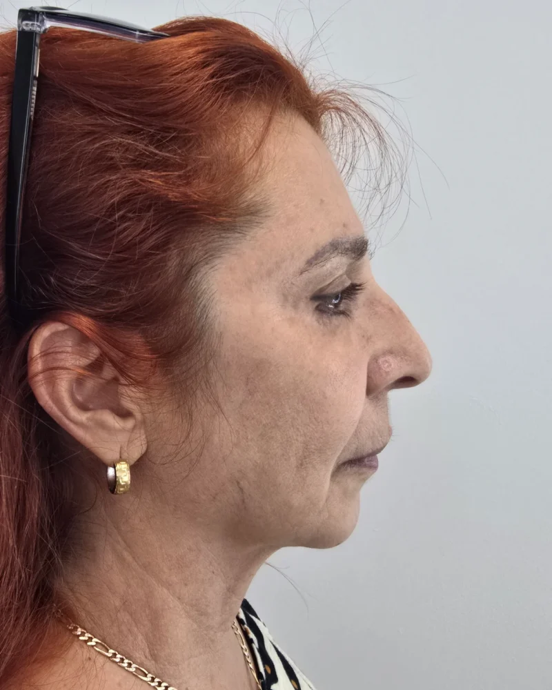 Deep plane λίφτινγκ προσώπου πριν: γυναίκα 50–60 ετών, 3 μήνες μετά την επέμβαση, λοξή λήψη δεξιά