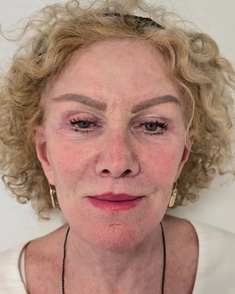Deep plane λίφτινγκ και lip lift και λίφτινγκ μετώπου και φρυδιών: 1 μήνας μετά την επέμβαση, μπροστά – γυναίκα 70+ ετών