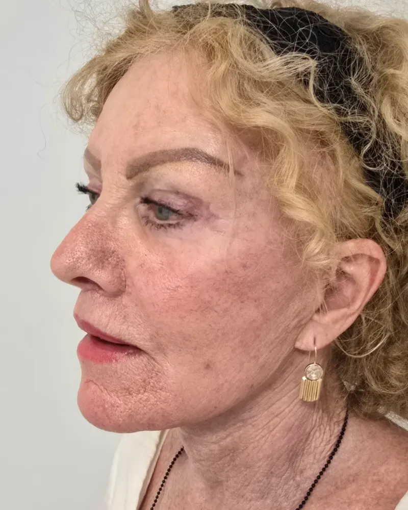 Deep plane λίφτινγκ και lip lift και λίφτινγκ μετώπου και φρυδιών: 1 μήνας μετά την επέμβαση, λοξή αριστερή – γυναίκα 70+ ετ…