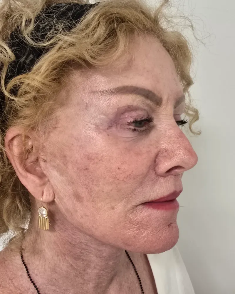 Deep plane λίφτινγκ και lip lift και λίφτινγκ μετώπου και φρυδιών: 1 μήνας μετά την επέμβαση, λοξή δεξιά – γυναίκα 70+ ετών